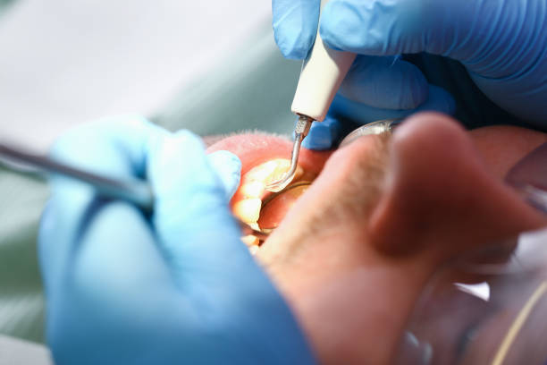Best Chipped Tooth Repair Near Me  in Wadley, GA